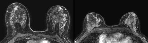 Elevated Mri Enhancement Helps Indicate Cancer Risk In Women With Very