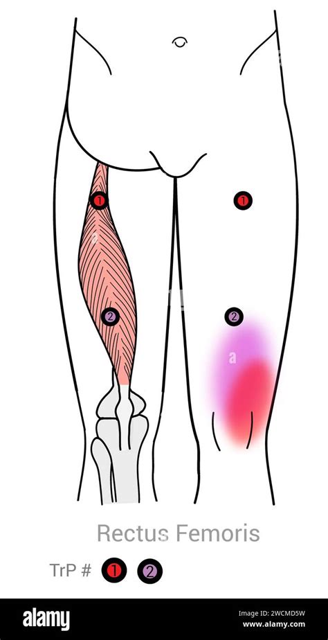 Rectus Femoris Myofascial Trigger Points And Associated Pain Locations