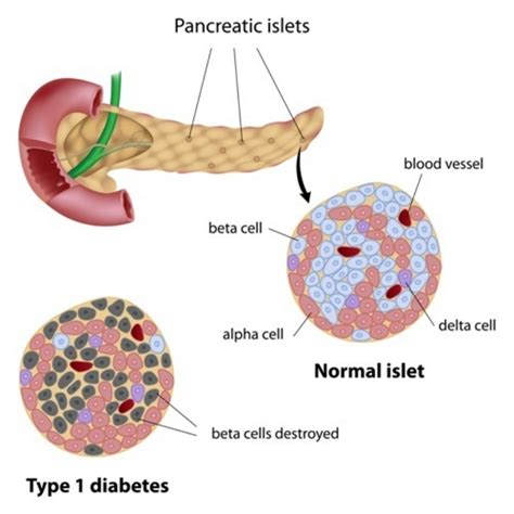 Swedish Researchers Find Pancreatic Islets Determine Ideal Blood Sugar ...