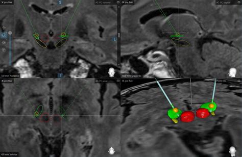 Dbs Electrodes Location In Nst All Exanimated Electrodes Are Displayed