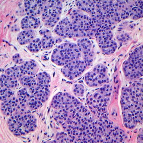 Inter Observer Variability Between General Pathologists And A