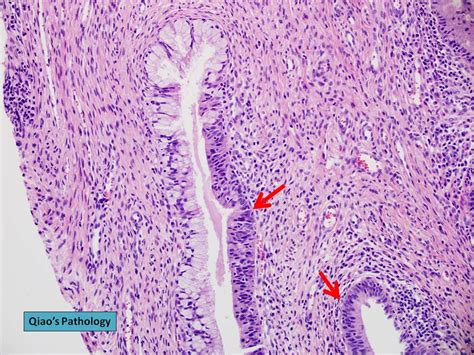 Qiao S Pathology Adenocarcinoma In Situ Ais Of Cervix Flickr