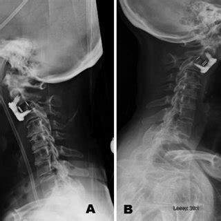 Repair Of Esophageal Perforation Due To Anterior Cervical Spine