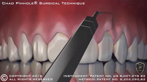 Chao Pinhole® Surgical Technique Pst Animation 2015 Youtube