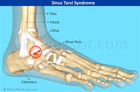 Sinus Tarsi Syndrome In Runners Doc Sinus Tarsi Syndrome In Runners