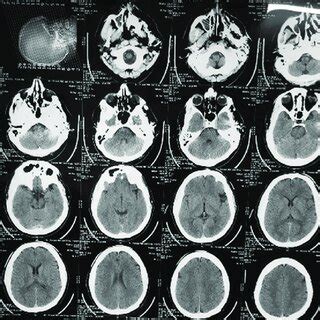 Preoperative Computed Tomography Scan Showing Normal Findings