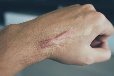 Scar Tissue Causes Prevention And Treatment