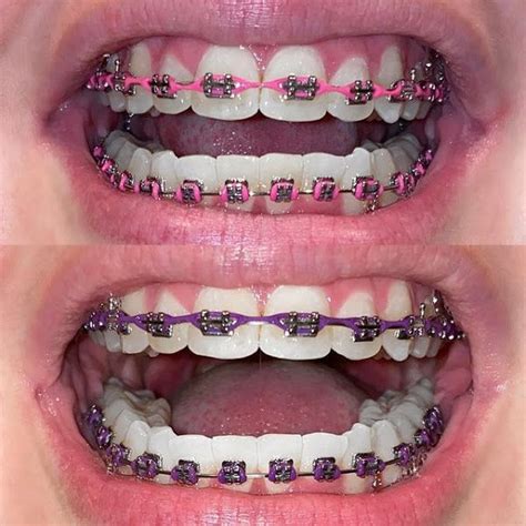 Dental Braces Colors Cute Braces Colors Braces Bands Braces Tips