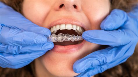 The Importance Of Compliance During Clear Aligner Treatment Str8™ Aligners