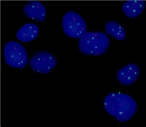 FISH Analysis Using Vysis LSI TP53 Spectrum Orange CEP 17 Spectrum