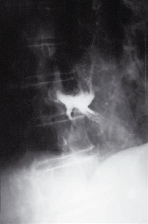 Water Soluble Contrast Medium Esophagogram Obtained On Admission Shows Download Scientific