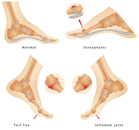 What is Turf Toe? - Sterling Foot Doctor Shuman Podiatry & Sports Medicine