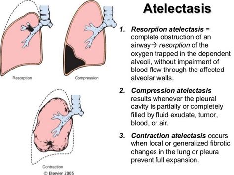 Types Of Atelectasis Respiratory Therapy Notes Respiratory Therapy