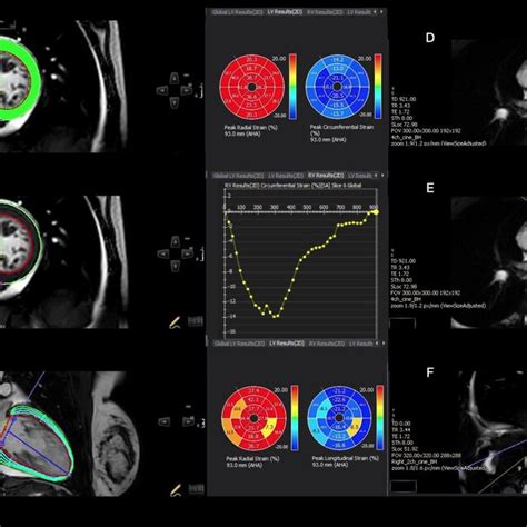 Example Showing Ventricular Circumferential Radial And Longitudinal