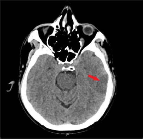 Ct Head Showing Hypodense Lesion In Left Temporal Lobe Arrow Possible