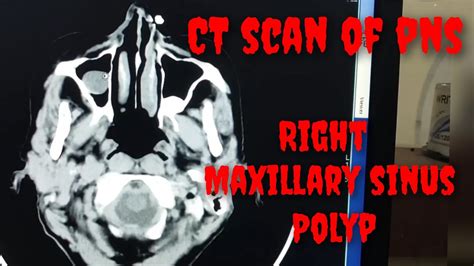 Right Maxillary Sinus Polyp Ct Scan Of Pns Ct Scan Of Brain