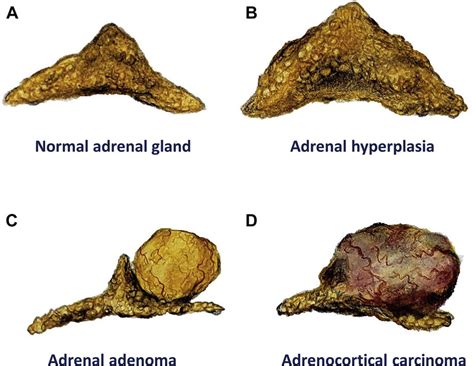 Adrenal Cortical Adenoma Histology