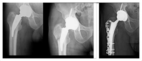 Radiographic Pictures Of Femoral Stem Revision With Conventional Stem Download Scientific