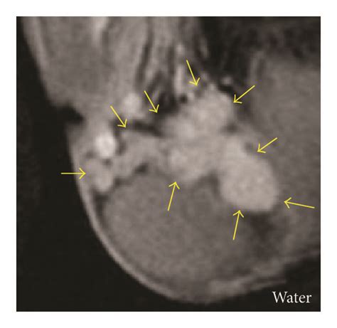 Imaging Of The Fibrous Pseudotumor In The Scrotum Scrotal Ultrasound