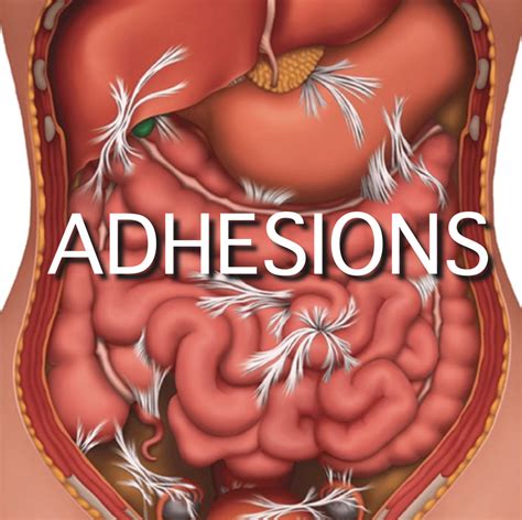 What Is Abdominal Adhesiolysis Hill Regional Hospital