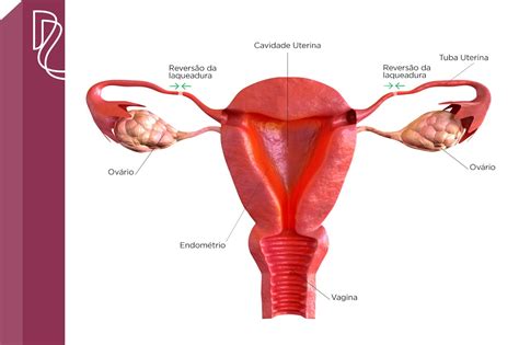 Revers O Da Laqueadura Dra Rosane Rodrigues Especialista Em