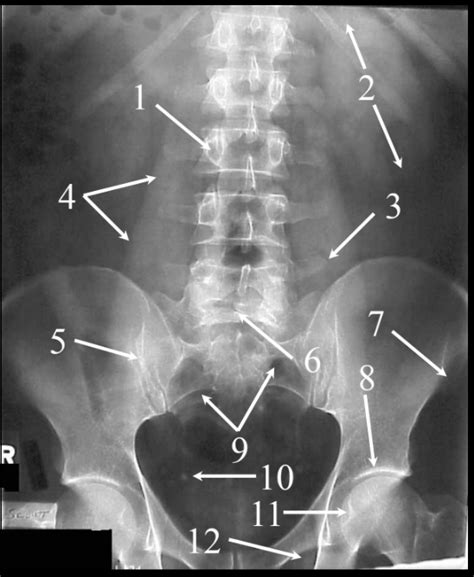 kub xray labeled  hayden atkin blog