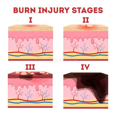 Fourth Degree Burn Diagram