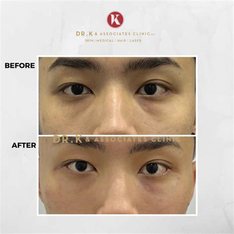 Dermal Filler Malaysia For Effective Treatment Dr K And Associates