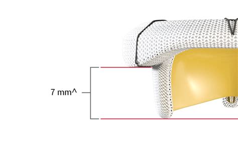 Mitris Resilia Mitral Valve Edwards Lifesciences