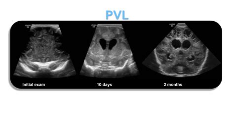 Neonatal Neurosonography Sonographic Tendencies