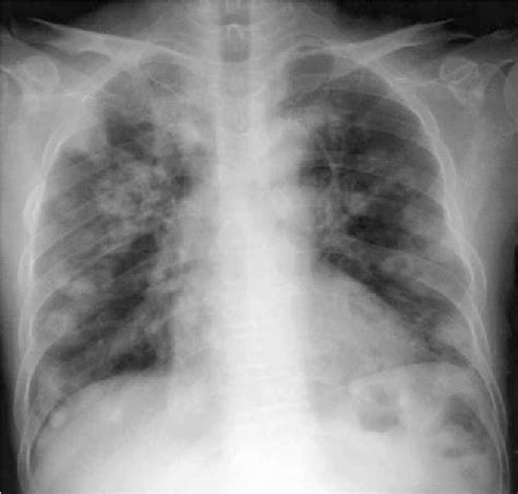 Figure 1 From Pulmonary Nocardiosis With Multiple Cavitary Nodules In A Hiv Negative