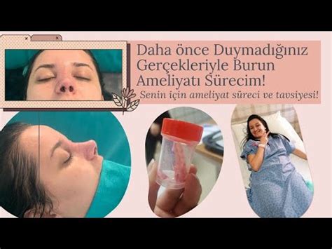 RİNOPLASTİ Ameliyatı Tüm Gerçekleriyle BURUN AMELİYATI Sürecim YouTube