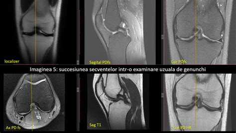 Protocol De Investiga Ie Prin Rezonan Magnetic Pentru Genunchi