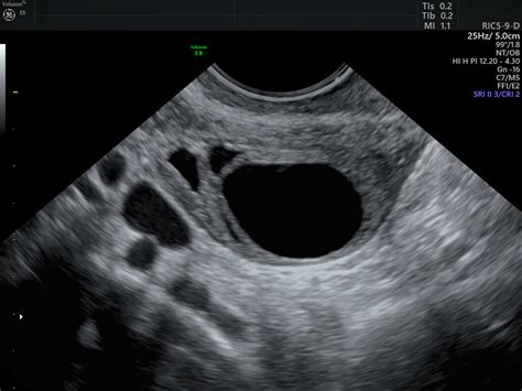 Simple Vs Complex Ovarian Cysts The Link To Ovarian Cancer