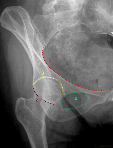 Radiopaedia Case Adult Normal Pelvis Annotated Obturator Oblique View