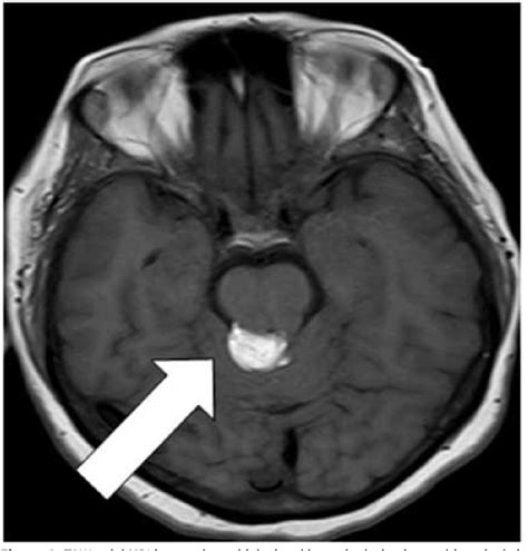 Figure 2 From Quadrigeminal Plate Cistern Lipoma Semantic Scholar