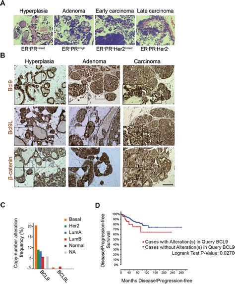 Bcl9 And Bcl9L Are Highly Expressed In Invasive Breast Cancers A