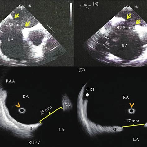 Baseline Two Dimensional Transthoracic Echocardiogram Color Doppler