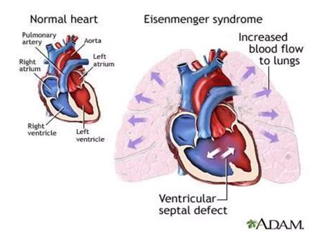 Ventricular Septal Defects Echocardiography Ppt