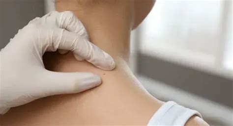 Birthmark Removal in West Hills, CA | Expert Dermatology