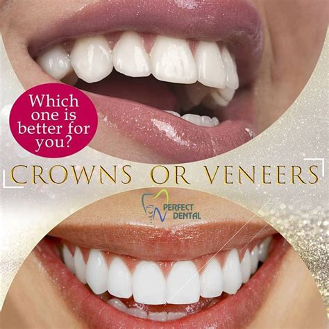 Dental Crowns Vs Veneers Understanding The Differences