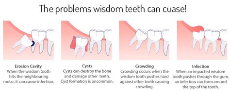 Wisdom Tooth Dr Hussein Ahmed