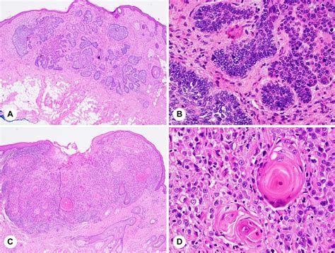 Basal Cell Carcinoma Vs Squamous Cell Carcinoma Histology