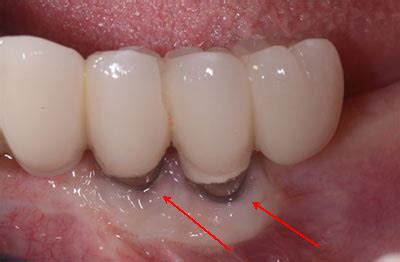 Dental Implant Infection Dental Implants Problems