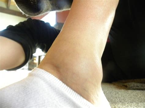 Top 10 Ways To Heal A Sprained Ankle Sprained Ankle Sprain Sprained