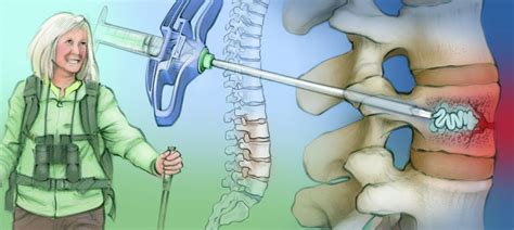 Vertebral Augmentation The Interventional Initiative