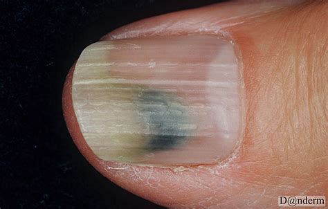 Pseudomonas Aeruginosa Nail Infection Nail Ftempo