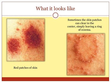 discoid eczema - pictures, photos