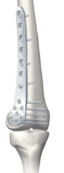 Lcp Distal Femur Plates Bions Medical Systems