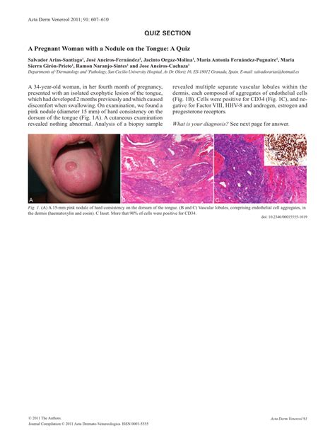 PDF A Pregnant Woman With A Nodule On The Tongue A Quiz Lobular